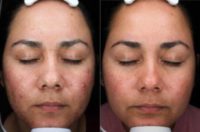 33 year old woman treated with VI Peel, Accutane for Active Acne, AviClear