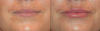 25-34 year old woman treated with Juvederm