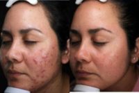 33 year old woman treated with VI Peel, Accutane for Active Acne, AviClear