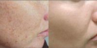 25-34 year old woman treated with Scar Removal
