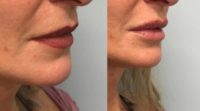 25-34 year old woman treated with Lip Fillers