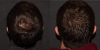 25-34 year old man treated with PRP for Hair Loss