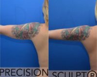 25-34 year old woman treated with Arm Liposuction