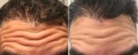 35-44 year old man treated with Botox