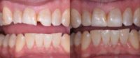 35-44 year old man treated with Dental Bonding