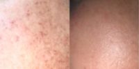 35-44 year old woman treated with Laser Treatment