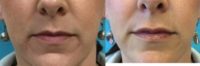 35-44 year old woman treated with Juvederm Volbella and Vollure