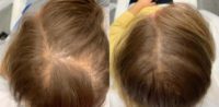 35-44 year old woman treated with Hair Loss Treatment