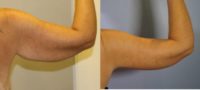 35-44 year old woman treated with Arm Lift