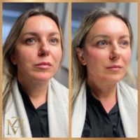 35-44 year old woman treated with Nonsurgical Facelift, Radiesse
