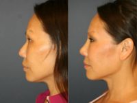 40 year old woman treated with Asian Rhinoplasty