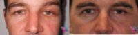 41 year old male treated with upper blepharoplasty