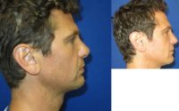 42 year old male for revision rhinoplasty