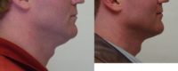42 yr old male for liposuction to correct excess fat neck