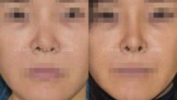 35-44 year old woman treated with Revision Asian Rhinoplasty