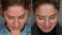 35-44 year old woman treated with Rhinoplasty, CO2 Laser, Facial Fat Transfer