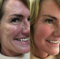 45-54 year old woman treated with Radiesse filler for wrinkles