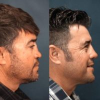 45-54 year old man treated with Revision Rhinoplasty