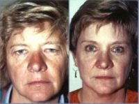 45-54 year old woman treated with Eyelid Surgery and Browlift