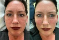45-54 year old woman treated with Vampire Facelift