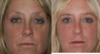 45-54 year old woman treated with Laser Resurfacing
