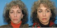 51 year old woman treated with Facelift, endoscopic brow lift and 4 lid blepharoplasty