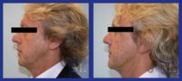 45-54 year old male treated with Facelift