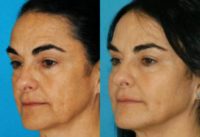 45-54 year old woman treated with Laser Treatment