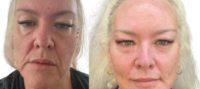 45-54 year old woman treated with Facelift, Deep Plane Facelift