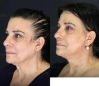 53 year old woman treated with Facelift