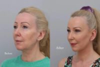 55-64 year old woman treated with Deep Plane Facelift, Neck Lift, Eyelid Surgery