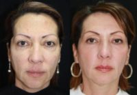 55-64 year old woman treated with Non Surgical Face Lift, AmayaPeel