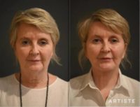 57 year old woman treated with Neck Lift