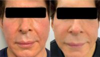 58 year old man treated with full face Erbium Laser Treatment