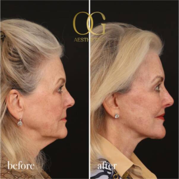 55-64 year old woman treated with Brow Lift, Deep Plane Facelift, Lip Lift, Eyelid Surgery, CO2 Laser, Facial Fat Transfer