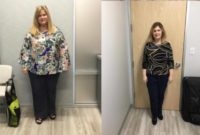 55-64 year old woman treated with Gastric Sleeve Surgery