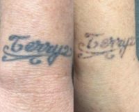 55-64 year old woman treated with Tattoo Removal