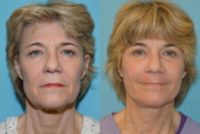 55-64 year old woman treated with Facial Fat Transfer