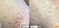55-64 year old woman treated with Asclera for spider veins