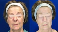 55-64 year old woman treated with Dermal Fillers, Microneedling RF