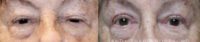 55-64 year old woman treated with Ptosis Surgery