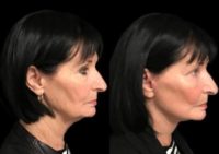 65-74 year old woman after Facelift Surgery