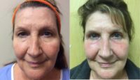 65-74 year old woman treated with Laser Resurfacing
