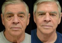 65-74 year old man treated with Injectable Fillers