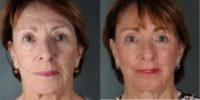 70 year old woman treated with Laser Resurfacing