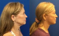 71 year old female who had a face/neck lift.