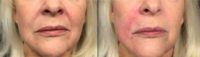 65-74 year old woman treated with Juvederm