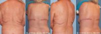 65-74 year old woman treated with Body Lift