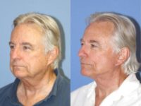 65-74 year old man treated with Facelift