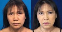 65-74 year old woman treated with FaceTite